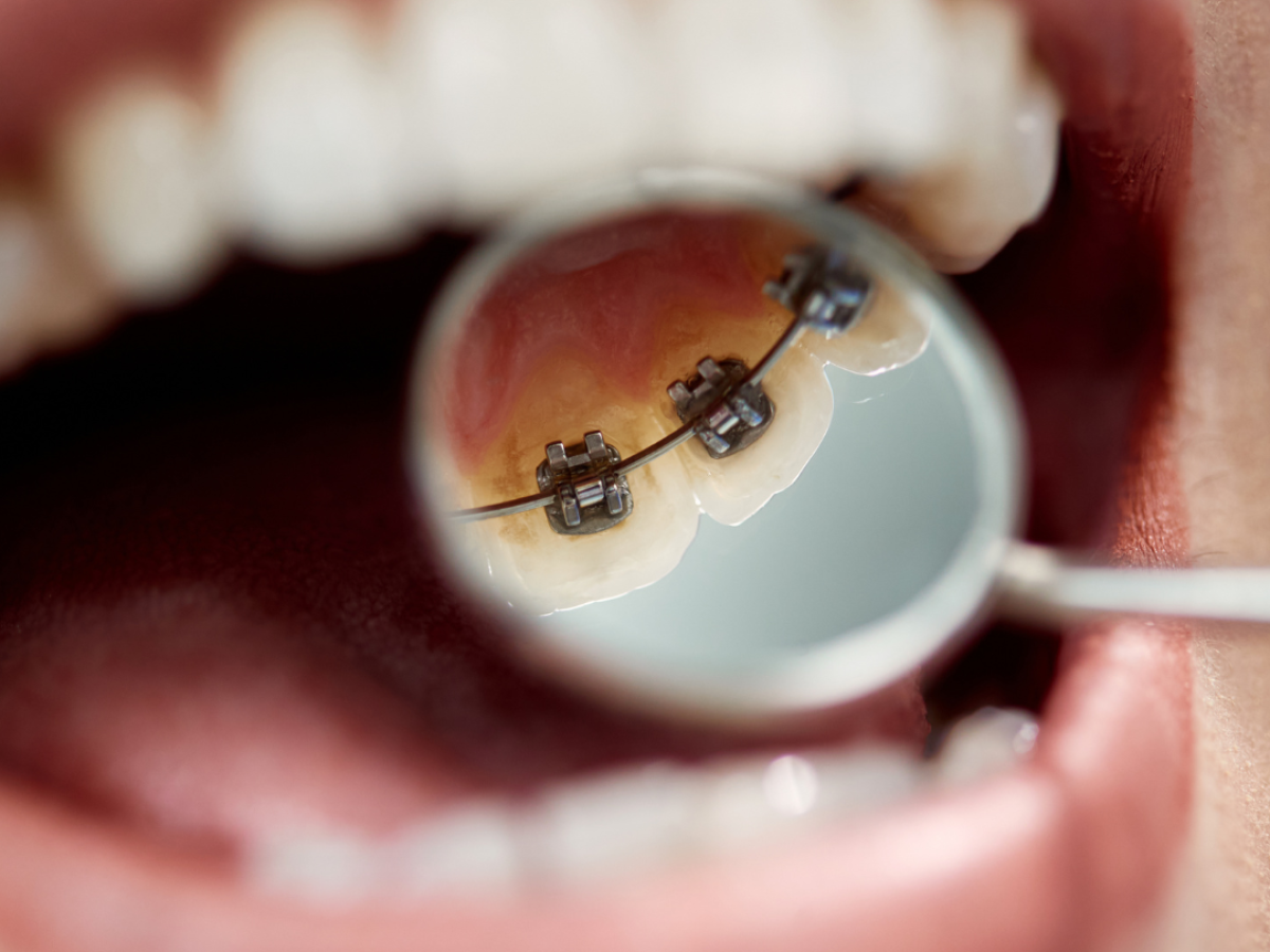 Ortodoncia Lingual: Mitos y verdades de esta innovadora solución para tener una sonrisa perfecta 
