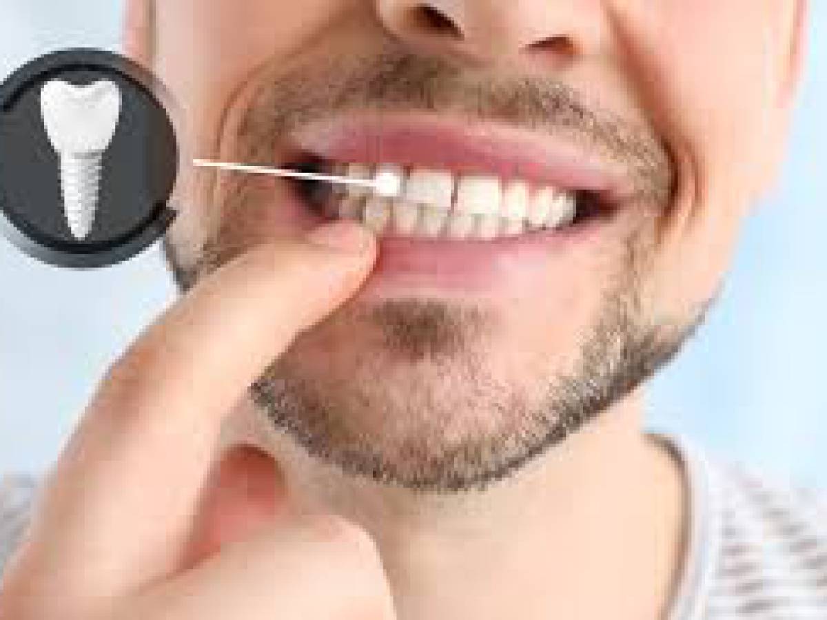 Pérdidas dentales: ¿Por qué los implantes son la solución más efectiva?