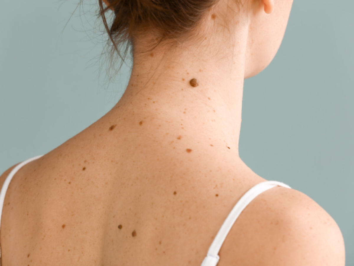 Día del Cáncer de piel: cómo prevenir el melanoma