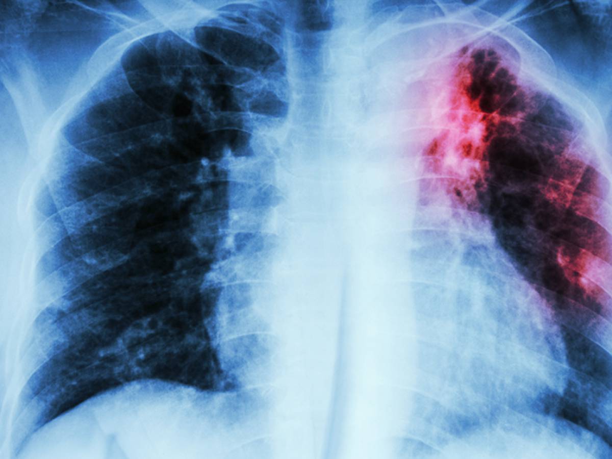 Confirman caso de tuberculosis en adulto mayor de Pinto y refuerzan medidas sanitarias